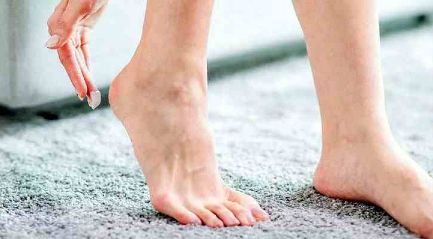 Health tips to prevent cracked feet